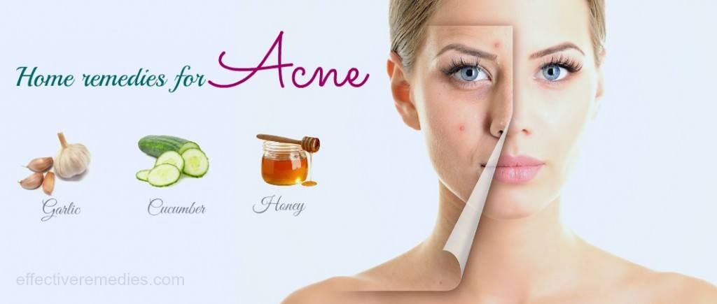 home remedies for acne