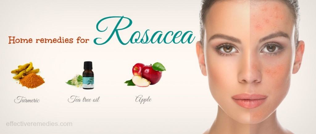 home remedies for rosacea