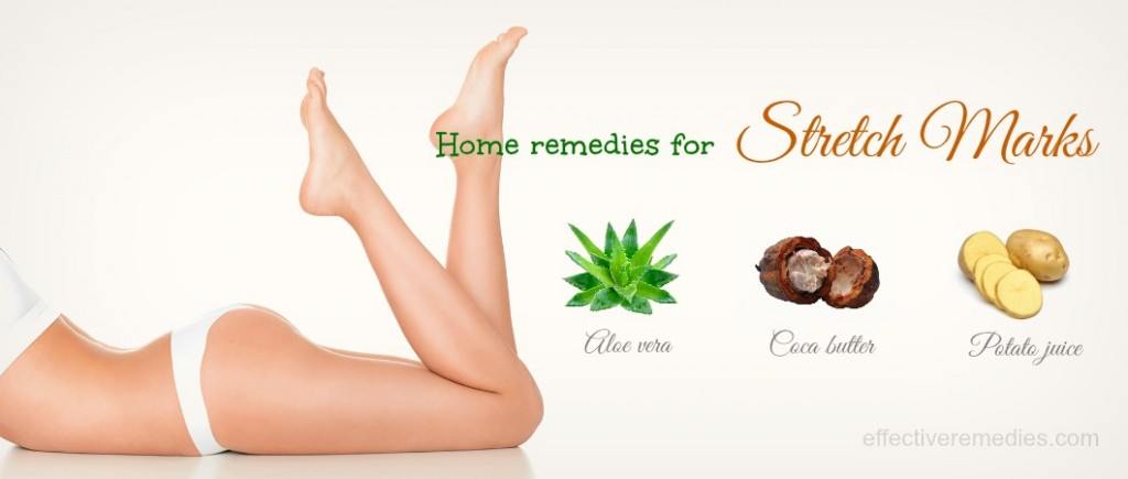 home remedies for stretch marks