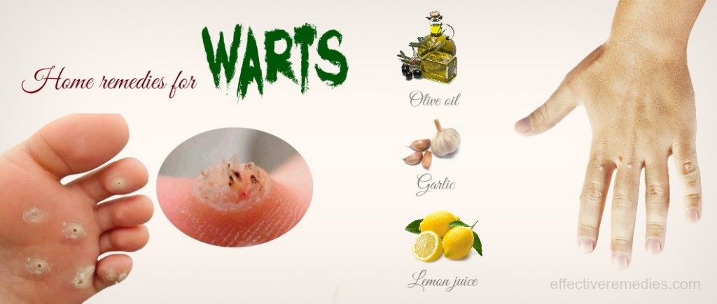 home remedies for warts