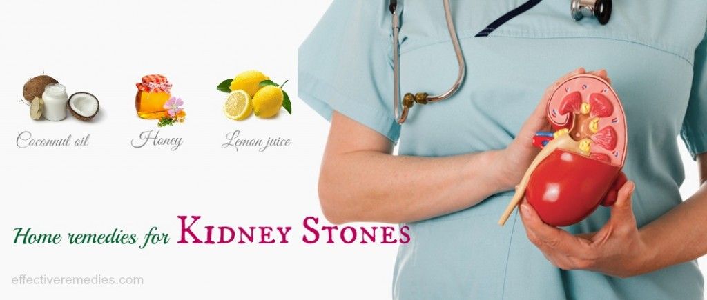 home remedies for kidney stones