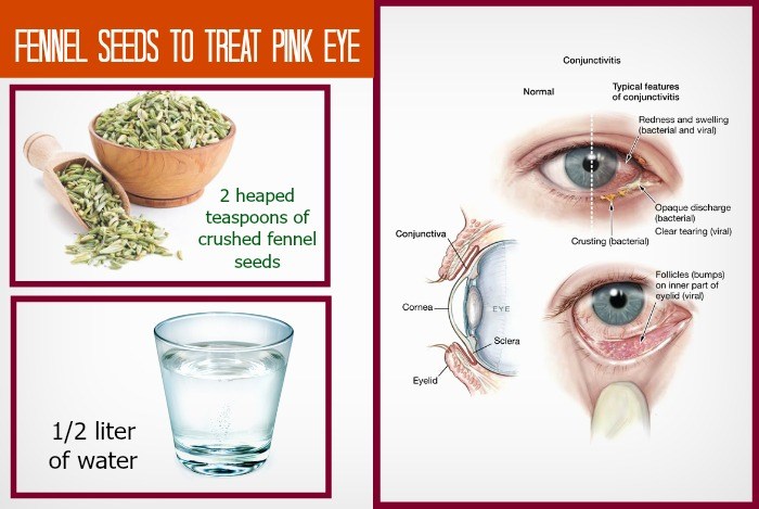 home remedies for pink eye 