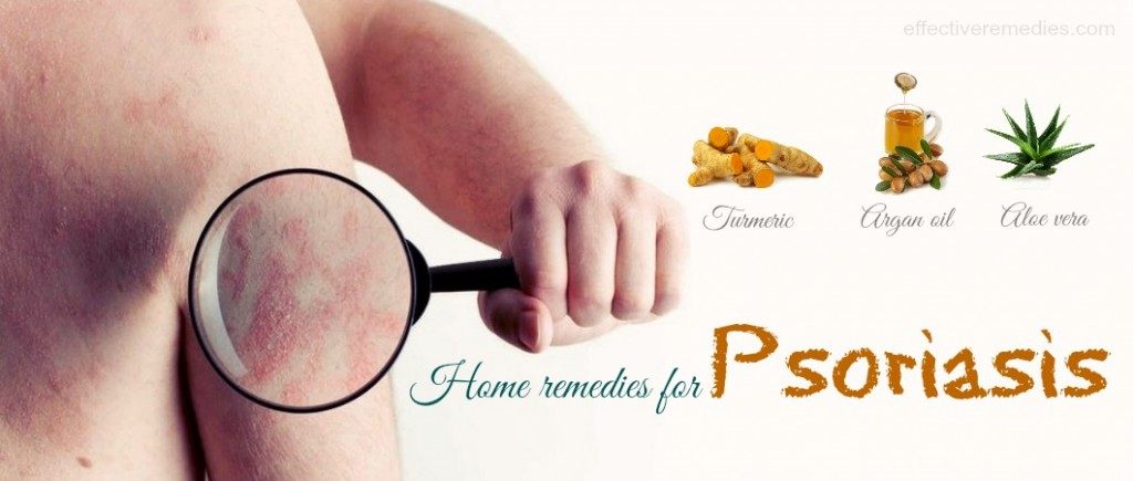 home remedies for psoriasis