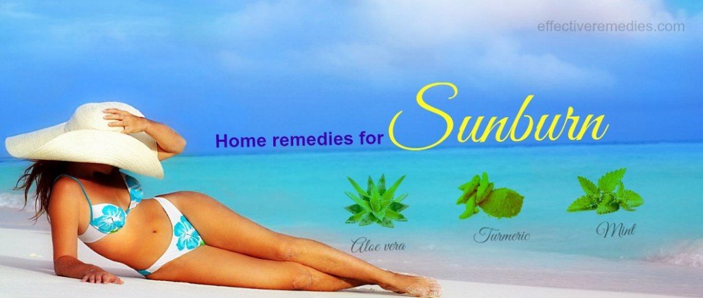 home remedies for sunburn