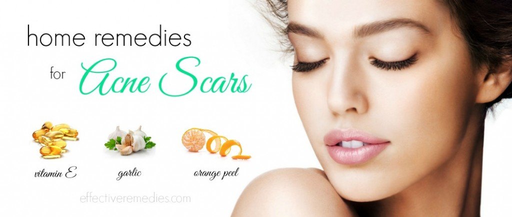 home remedies for acne scars