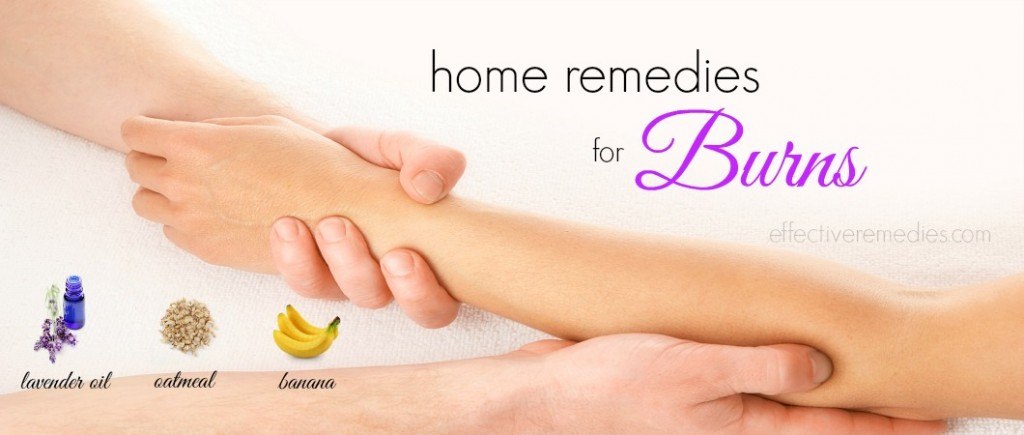 home remedies for burns