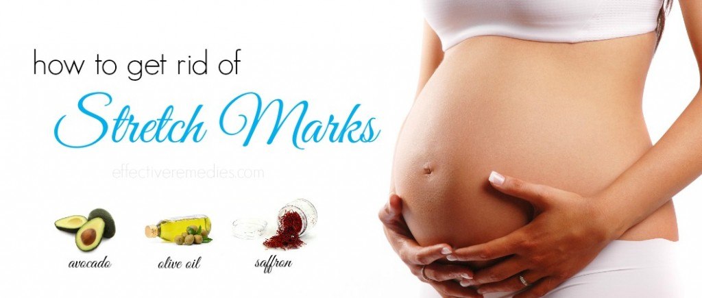 how to get rid of stretch marks