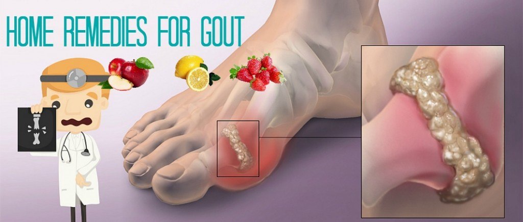 home remedies for gout