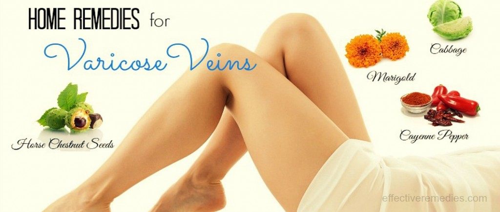 home remedies for varicose veins