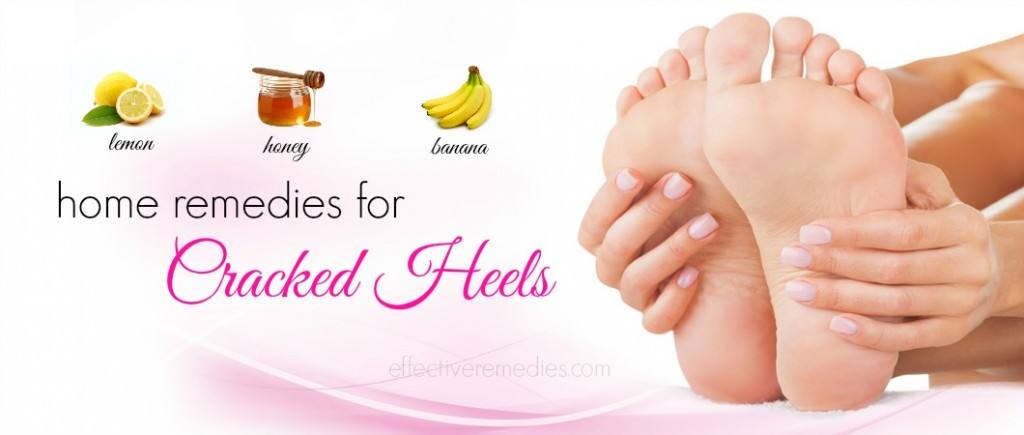 home remedies for cracked heels