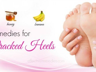 home remedies for cracked heels