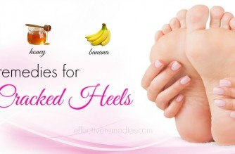 home remedies for cracked heels