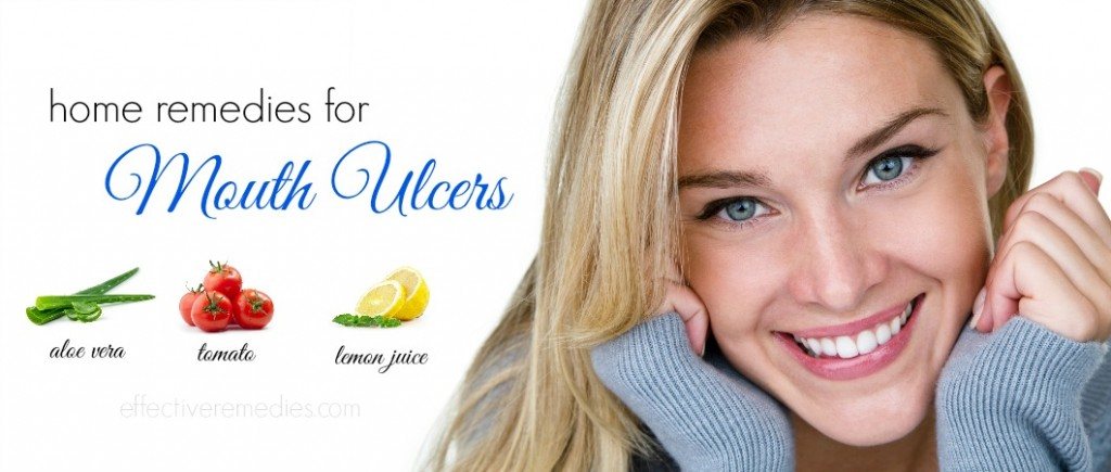 home remedies for mouth ulcers