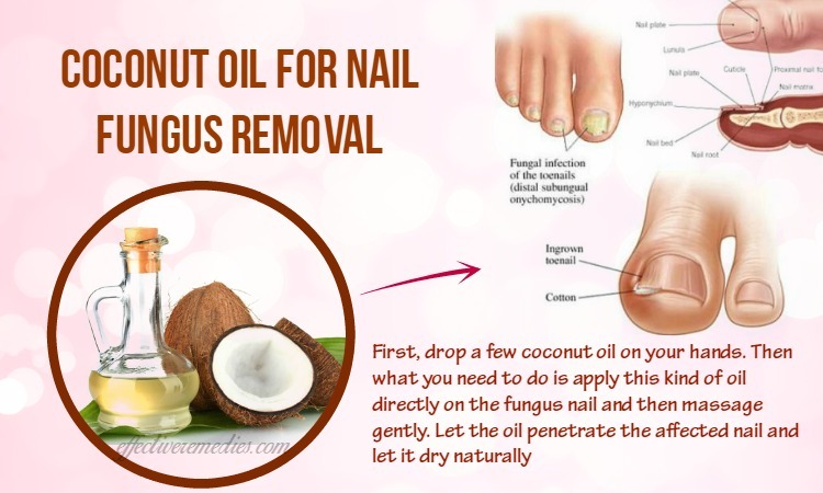 Top 16 Natural Home Remedies For Nail Fungus Removal 7688