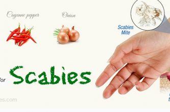 home-remedies-for-scabies