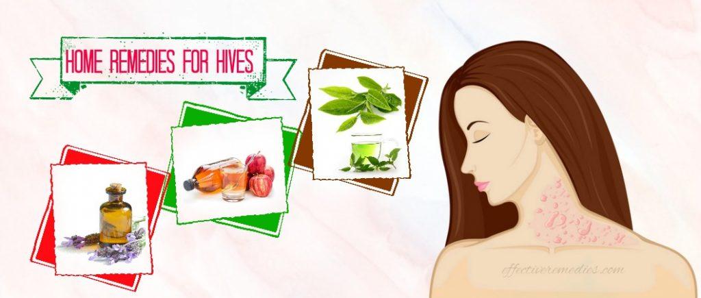 home remedies for hives