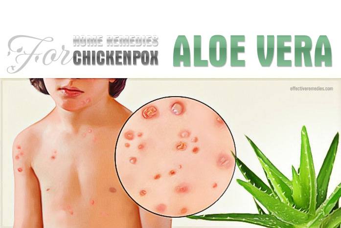 home remedies for chickenpox - aloe vera