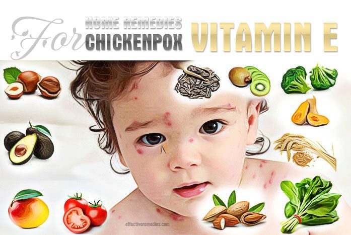 home remedies for chickenpox - vitamin e