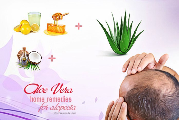 home remedies for alopecia - aloe vera