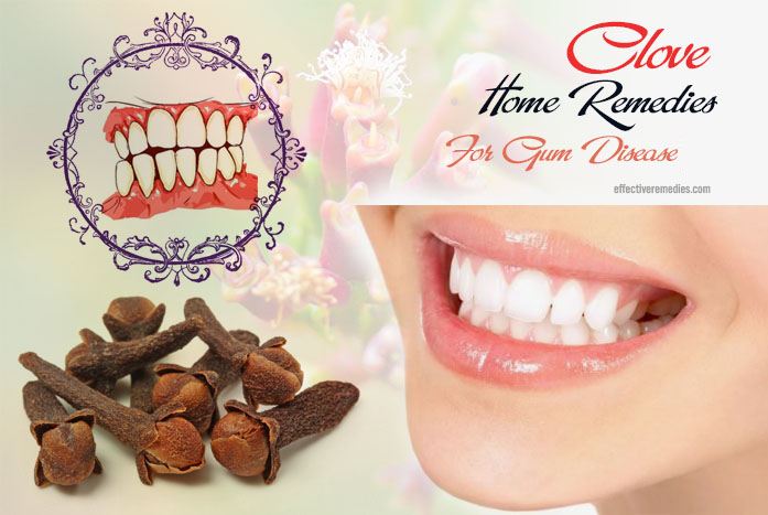 home remedies for gum disease - clove