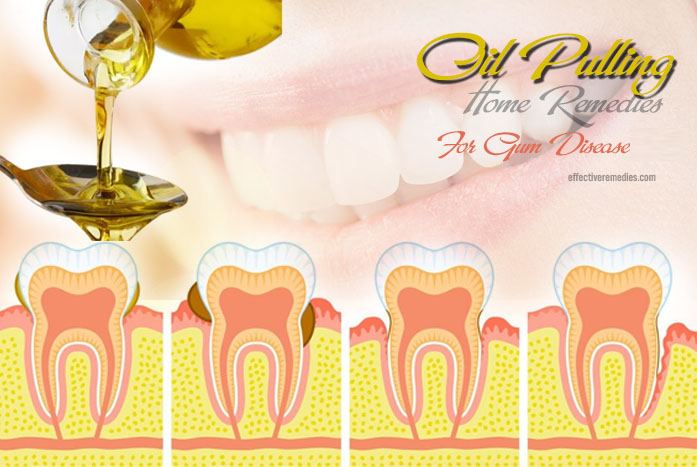 home remedies for gum disease - oil pulling