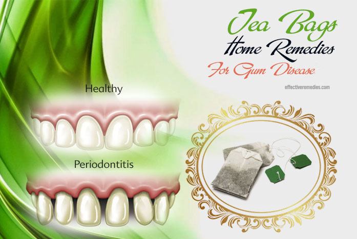 home remedies for gum disease - tea bags