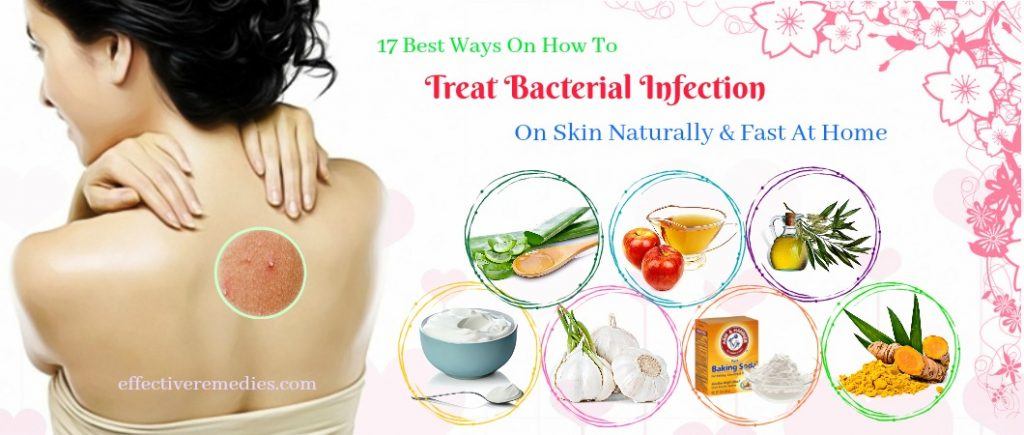 how to treat bacterial infection on skin