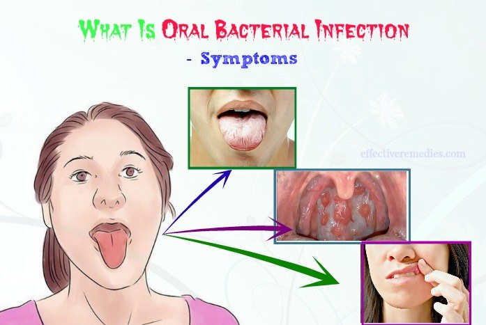 Bacterial Infection On Tongue 8633