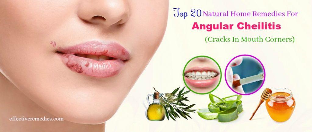 angular cheilitis