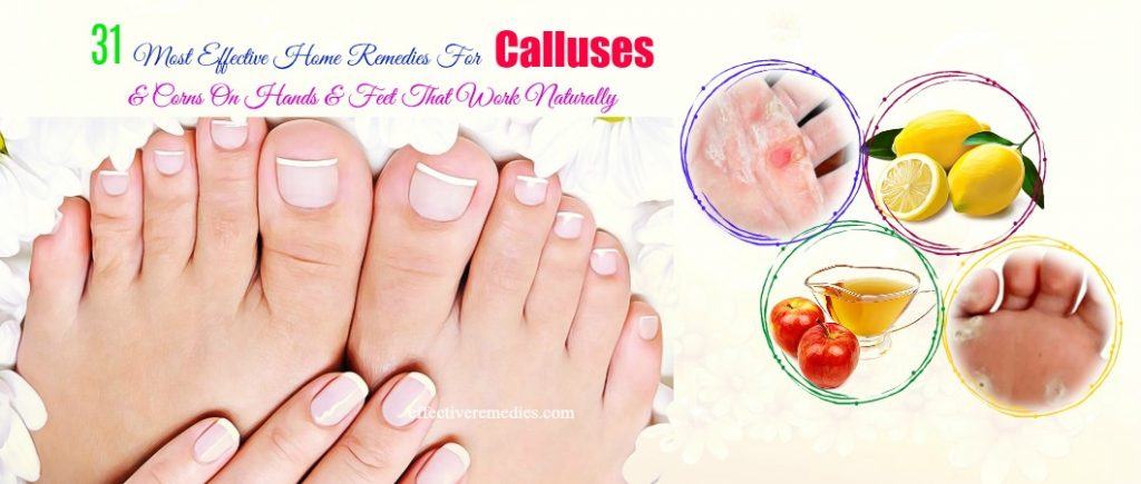 effective home remedies for calluses