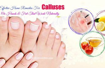 effective home remedies for calluses