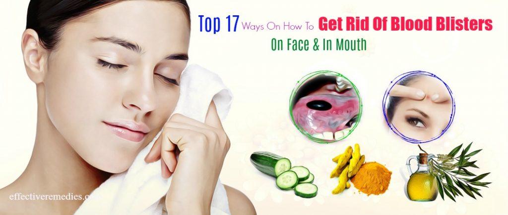 how to get rid of blood blisters on face