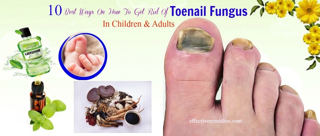 how to get rid of toenail fungus in children