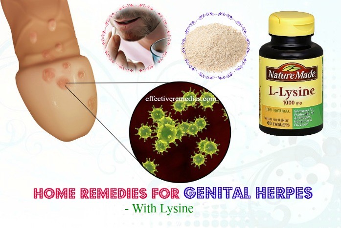 27 Effective Home Remedies For Genital Herpes Natural And Safe 8334