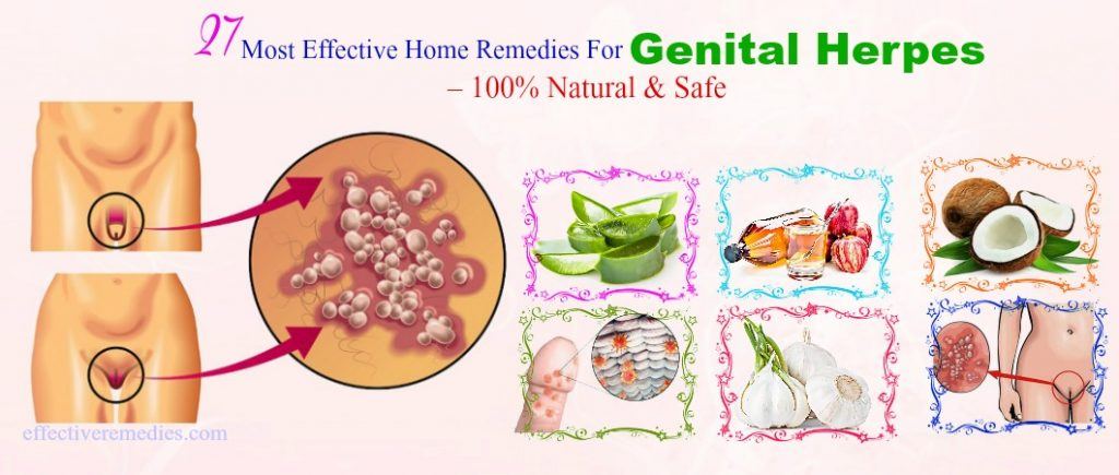 safe home remedies for genital herpes