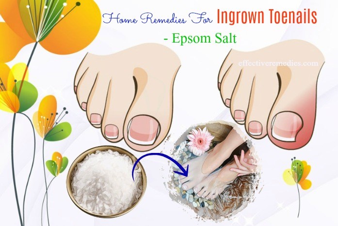 What Does Epsom Salt Do For Ingrown Toenail