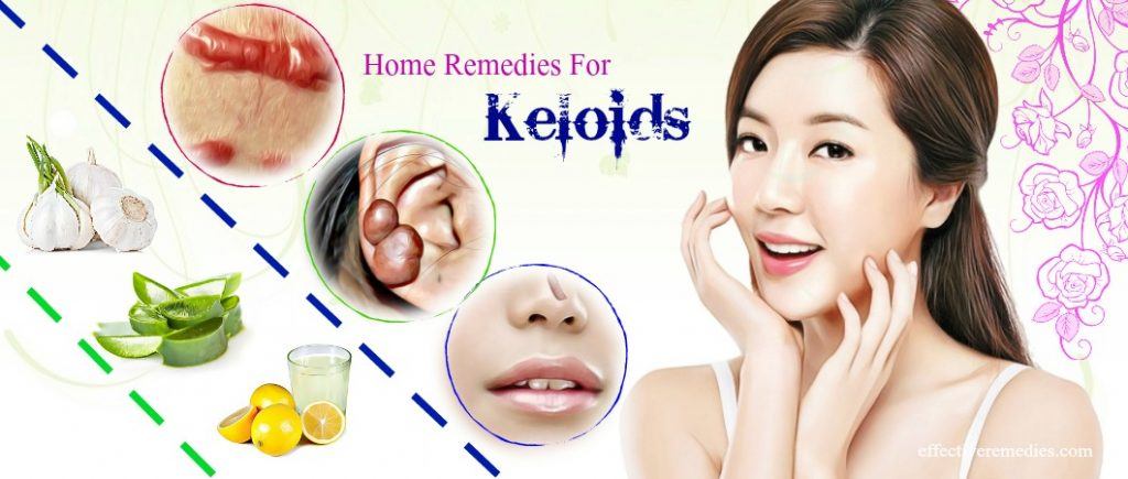 effective home remedies for keloids