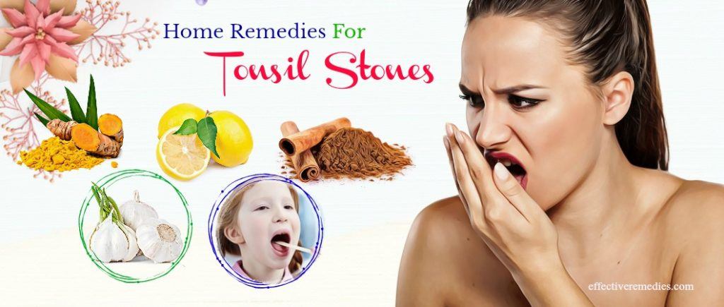 home remedies for tonsil stones and bad breath