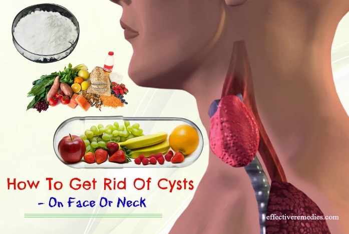 17 Best Ways How To Get Rid Of Cysts In Breast, On Neck Or ...