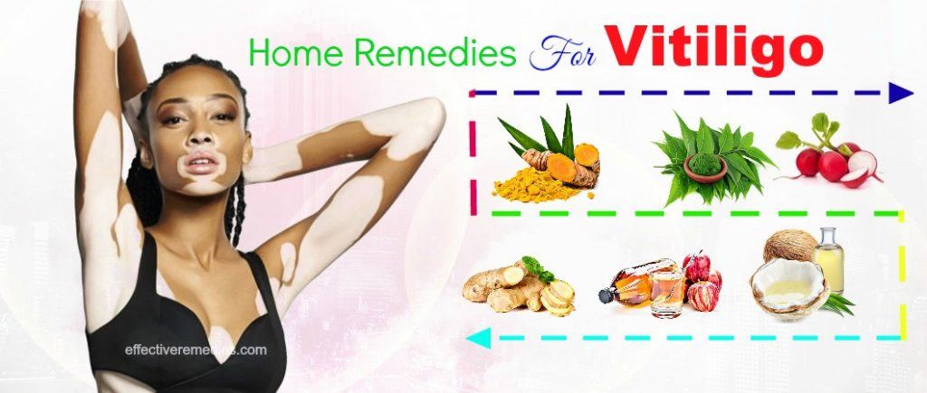 effective home remedies for vitiligo