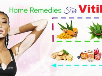 effective home remedies for vitiligo