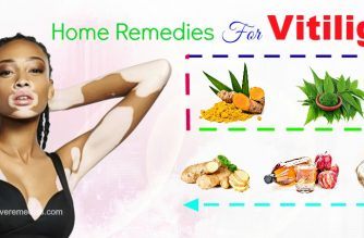 effective home remedies for vitiligo