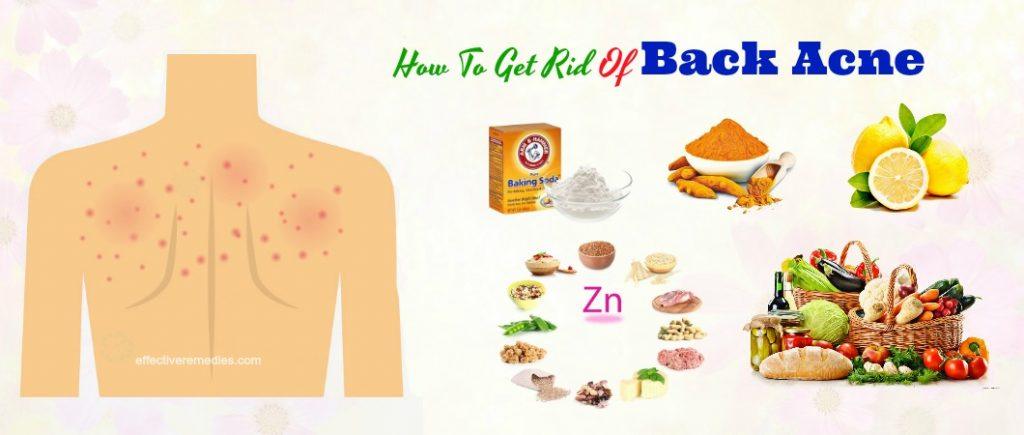 how to get rid of back acne at home