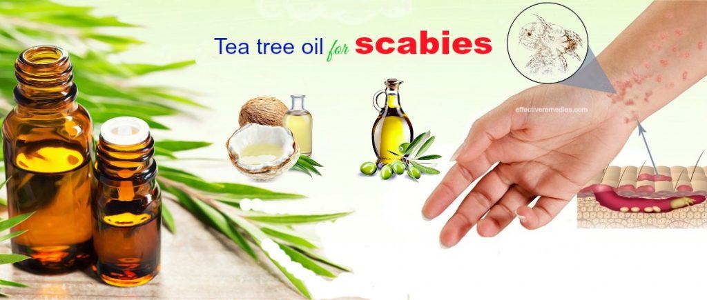 tea tree oil for scabies in kids