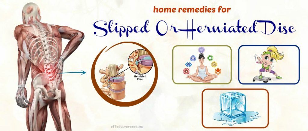 effective home remedies for slipped or herniated disc