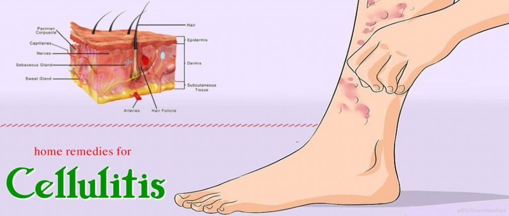 home remedies for cellulitis on face and body in adults and children