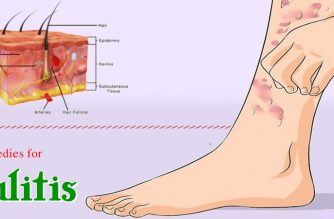 home remedies for cellulitis on face and body in adults and children