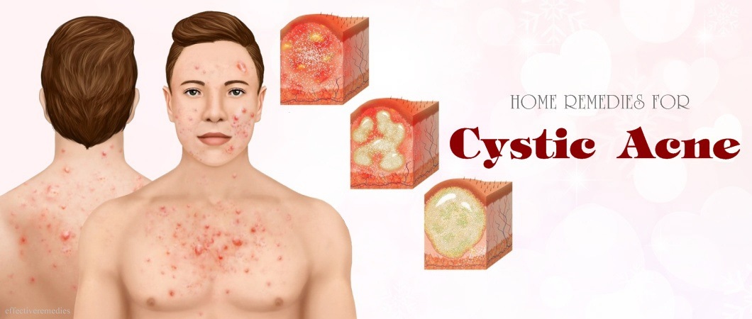 home remedies for cystic acne on face, nose, neck and while pregnant