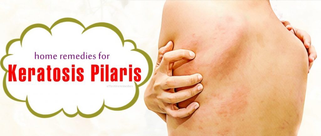 home remedies for keratosis pilaris on face