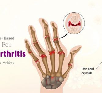 home remedies for rheumatoid arthritis relief in hands, fingers, knees, ankles